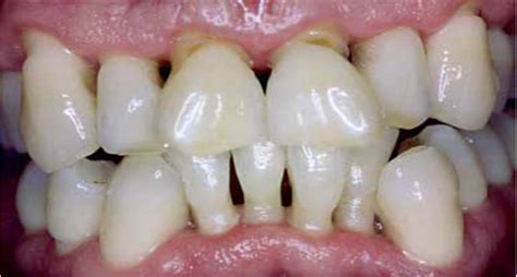 Desgaste Dental Definición Causas Y Tratamiento Nart Clínica Dental