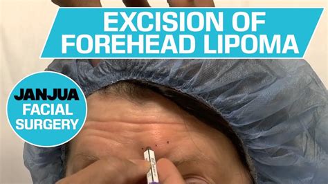 Lipoma Removal Surgery Cost