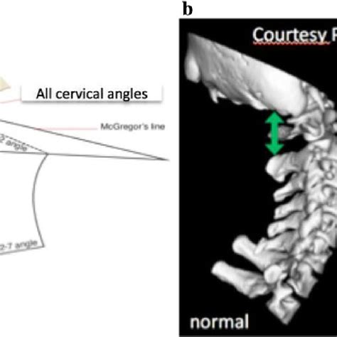 A Cervical Parameters High O C2 And Low C2 C7 Cervical Angles B