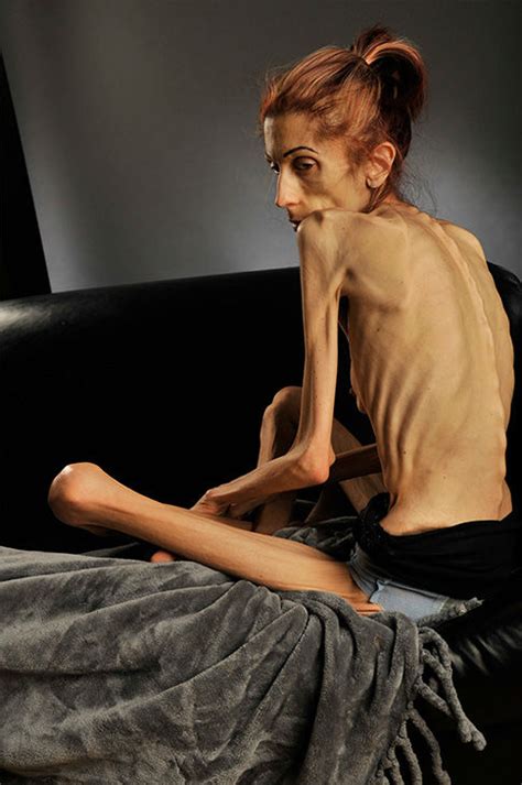 Photos California Woman Rachael Farokh Describes Her Shocking Descent Into Anorexia Abc Houston