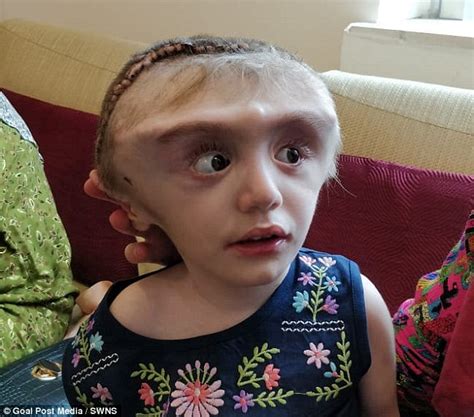 Tajikistan Girl With 28 Inch Head Caused By Deadly Build Up Of Fluid