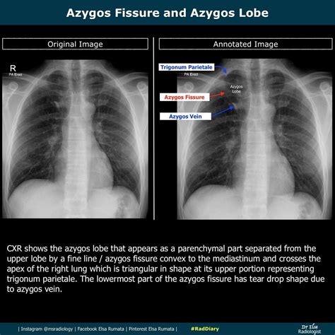 Azygos Fissure And Azygos Lobe Thoracic Radiology Medical