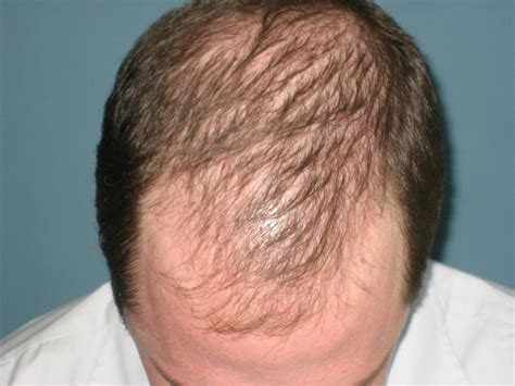 OMICS Publishing Group Various Types Of Hair Loss