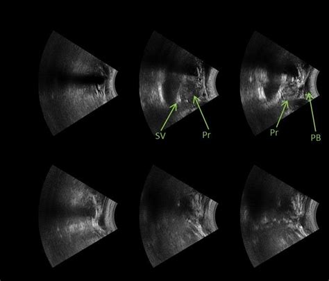 Sagittal B Mode Ultrasound Images Outside Of The Prostate O Within
