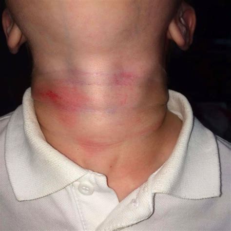 Boy Injured After Skipping Rope Strangling At School Central ITV News