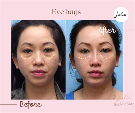 Eye Bags Jolie Filler Clinic