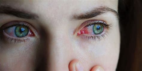 Conjunctivitis Pink Eye Symptoms Causes And Home Remedies Spectacular By Lenskart