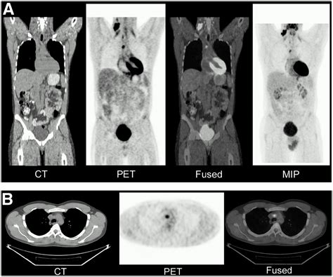 Integrating Pet And Petct Into The Risk Adapted Therapy Of Lymphoma