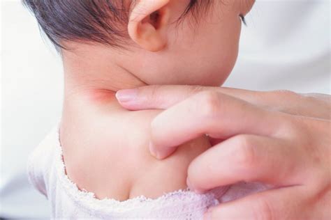 Baby Neck Rash In Infants Symptoms Home Remedies And Prevention