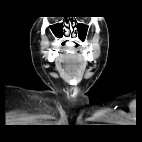 Supraclavicular Nodal Metastases Radiology Case