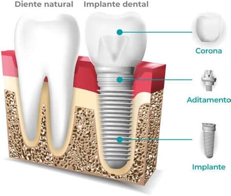 Sabemos que tanto un cepillo rotatorio como uno sónico son más cómodos de usar que uno manual. Implante dental • Dental Company