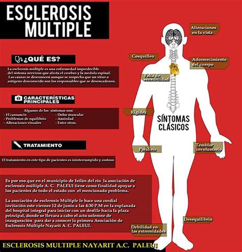 Jun 14, 2021 · mapi sánchez anuncia que padece esclerosis múltiple una de las españolas más destacadas en el world padel tour ha encontrado la explicación a sus problemas físicos en este diagnóstico. Asociación de Esclerosis Múltiple de Nayarit realizará ...