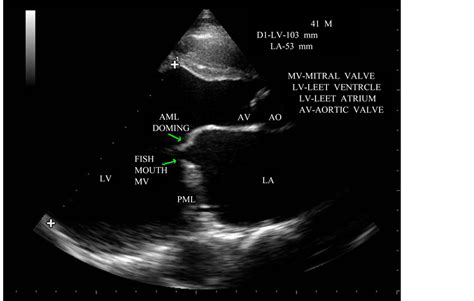 Rheumatic Aortic Valve Disease With Mitral Stenosis—a Case Report