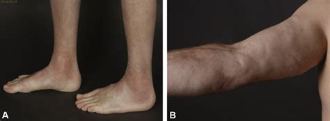 Long Term Outcome Of Eosinophilic Fasciitis A Cross Sectional