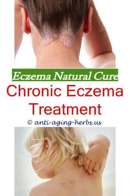 Scalp Eczema Shampoonystatin Cream For Eczemabest Lotion For Severe