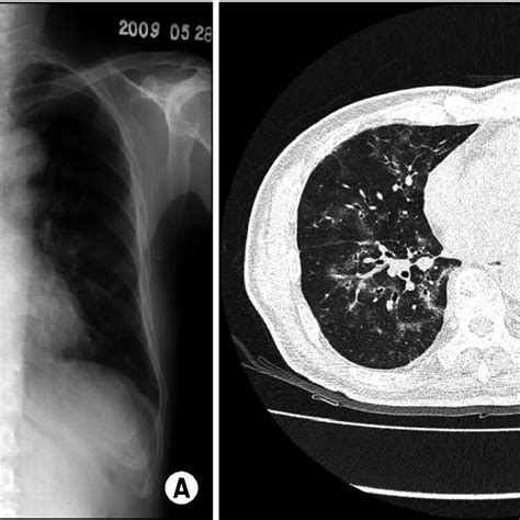 A Chest X Ray Shows Patchy Nodular Ground Glass Opacity Infiltrations