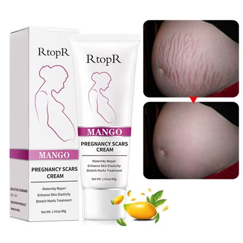 Stretch Mark Cream Pregnancy Repair Scar Line Abdomen Stretch Marks Cream New Ebay