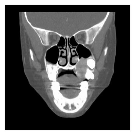 Ct Scan Of The Maxillofacial Region In Coronal View Showing A