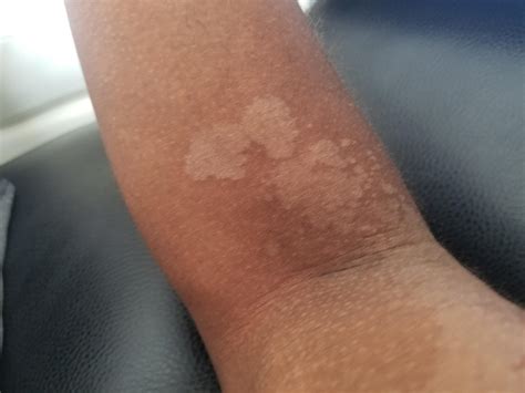 Skin Concern Weird Spots On Both Inner Arms Not Itchy Or Painful But