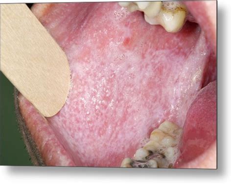 Oral Lichen Planus Disease Photograph By Dr P Marazzi Science Photo