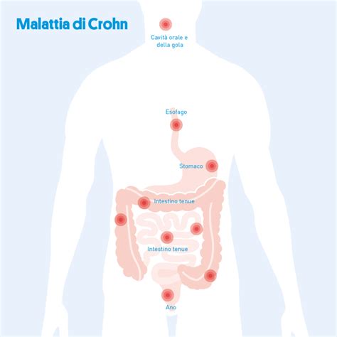 Morbo Di Crohn Che Cos Quali Sono I Sintomi E Come Si Cura Hot Sex Picture