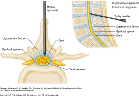 Spinal Epidural And Caudal Blocks Anesthesia Key