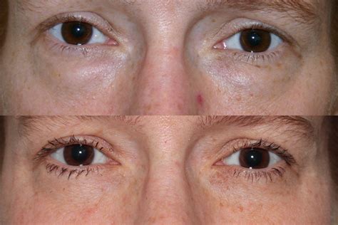 Before And After Lower Eyelid Surgery Dr Andrew B Denton