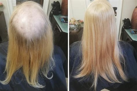 35 Hair Extensions For Thinning Crown Kahraibraheem