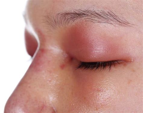 An Allergic Reaction That Causes the Eyes to Swell | LIVESTRONG.COM
