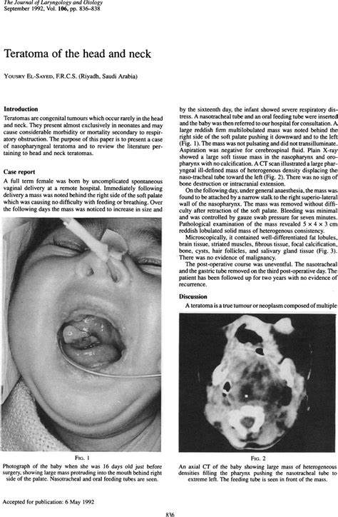 Teratoma Of The Head And Neck The Journal Of Laryngology And Otology