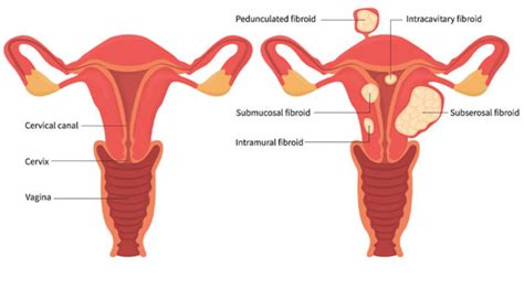 All You Need To Know About Uterine Fibroids Vascular Interventional