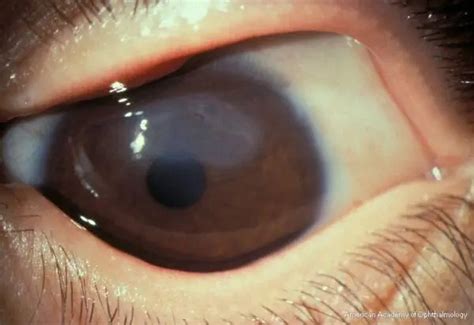 Vernal Keratoconjunctivitis American Academy Of Ophthalmology