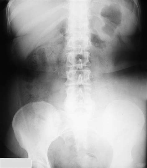 Pelvis X Ray Image Human Bone Ileum Stock Photos Pictures And Royalty