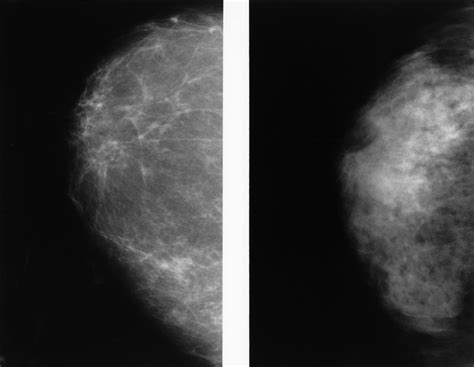 Mammogram Images Normal Abnormal And Breast Cancer