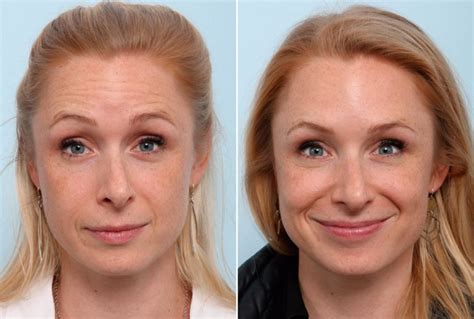 Here are some before and after photos of my clients here in london, w1. Botox® Cosmetic Photos (With images) | Botox cosmetic ...