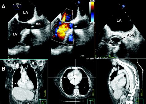 Diagnosis Of Prosthetic Aortic Valve Endocarditis With Gallium 67