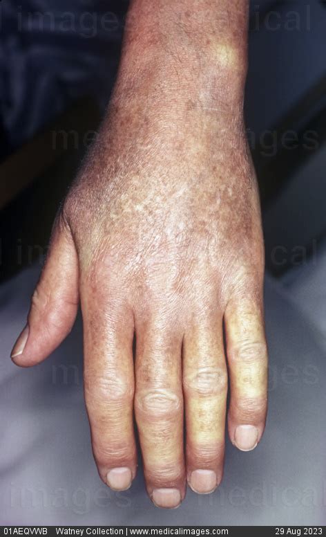 Stock Image Close Up Of Scleroderma With Inflammation And Thickening