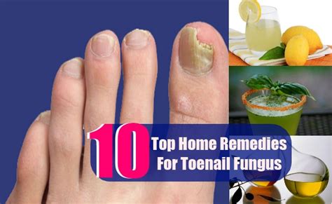 10 Top Home Remedies For Toenail Fungus Lady Care Health