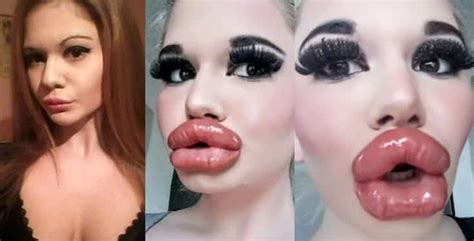 Real Life Barbie Shows Off Giant Lips After 20th Filler Injection Video
