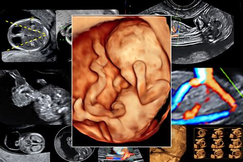 L écho morphogramme normal pathologique au premier trimestre de la grossesse PACT NECKER