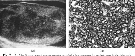 Figure 1 From A Case Of Primary Testicular Malignant Lymphoma