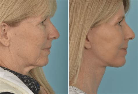 Platysmaplasty Utah Mobley Md Facial Plastic Surgeon