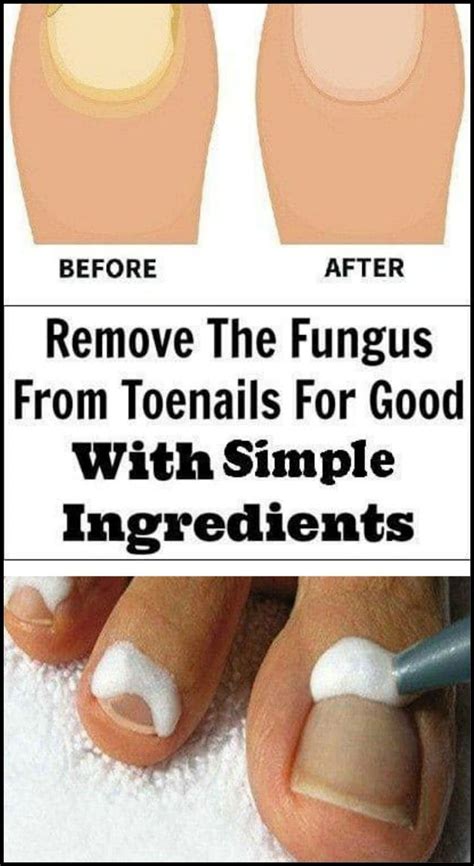 9 Simple Ingredients To Remove The Fungus From Toenails Healthy Prize