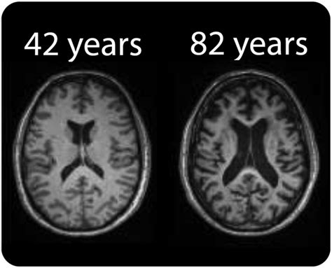 Mri Of Healthy Brain Aging A Review Macdonald 2021 Nmr In