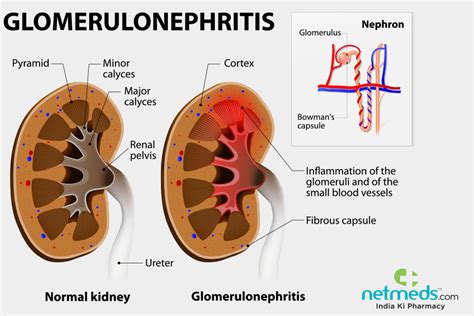 Glomerulonephritis Causes Symptoms And Treatment