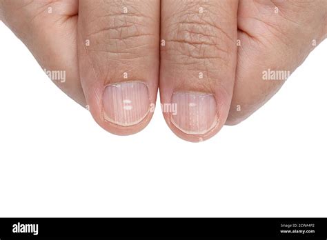 White Spots And Vertical Ridges On The Fingernails Stock Photo My Xxx