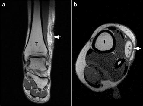 T1 Weighted Mri Images Showing Ln Of The Superficial Peroneal Nerve