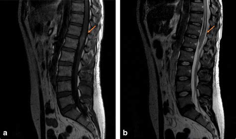 Sagittal Spine Mri Showing A Central Lesion In The Conus Medullaris