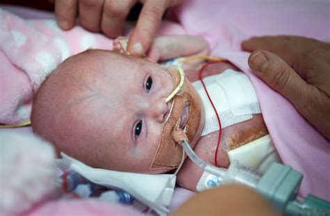 Miracle Baby Born With Heart Outside Of Body Survives Stars In