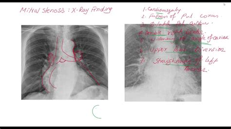 Mitral Stenosis X Ray Finding Youtube